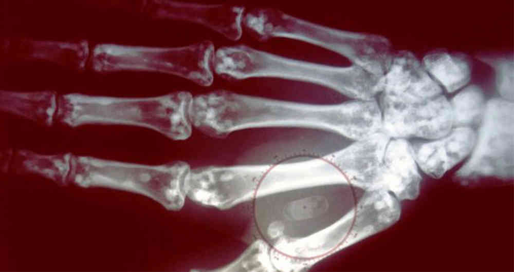 Cómo funcionan los microchips que se implantan bajo la piel y permiten pagar sin efectivo ni tarjeta